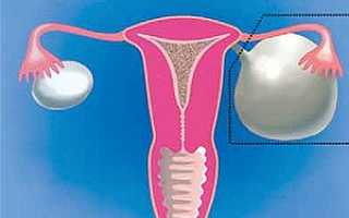 Кисты яичников — симптомы, признаки, клинические проявления, диагностика и методы лечения