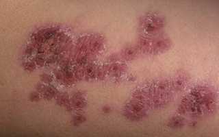 ЭРИТЕМА ЭКССУДАТИВНАЯ МНОГОФОРМНАЯ