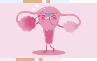 Синдром поликистозных яичников