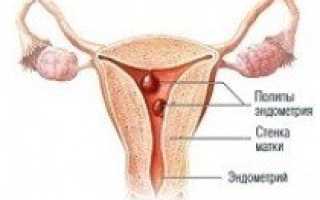 Причины, диагностика и лечение полипа матки