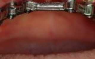 Зубной камень: фото, причины, удаление