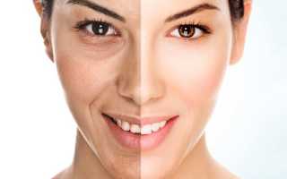 Диета для очищения кожи лица от прыщей и угревой сыпи