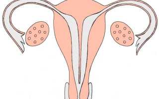 Внутриматочная перегородка