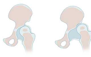 Дисплазия тазобедренного сустава