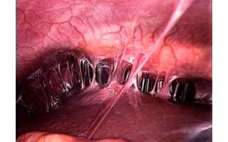 Внутриматочные синехии — сращения — синдром Ашермана