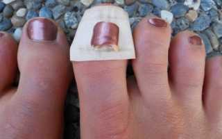 Лечение травм ногтя и ногтевого ложа