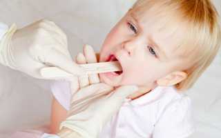 Стоматит у ребенка − что делать если язык вдруг побелел?