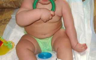 Паралич Эрба при родовой травме (паралич Эрба-Дюшенна, паралич Эрба-Дюшена)