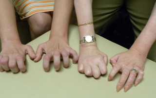 Болезнь Шарко-Мари-Тута: причины, лечение, прогноз