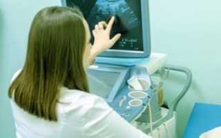 Чем опасна миома матки?