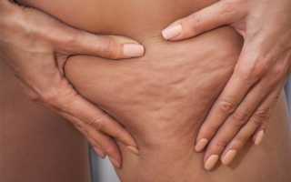 Как нужно худеть, чтобы избежать обвисания кожи и последующих операций?