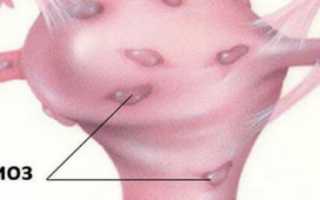 Эндометриоз и бесплодие: причины, симптомы