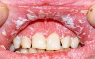 Чем снять опухоль десны в домашних условиях