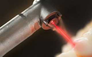 Инновационная технология имплантации зубов