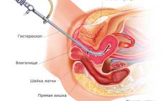 Что такое гистероскопия и как ее проводят