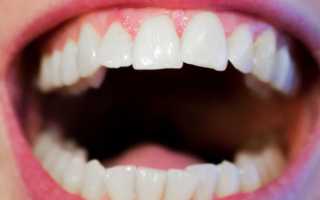 Протезирование передних зубов под ключ