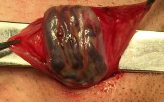 Варикоцеле