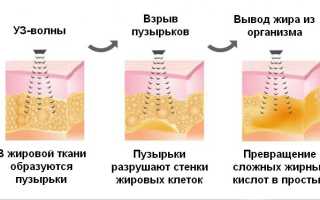 Ультразвуковая кавитация или LPG-массаж – что эффективнее?