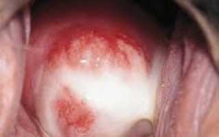 Хламидиоз у женщин