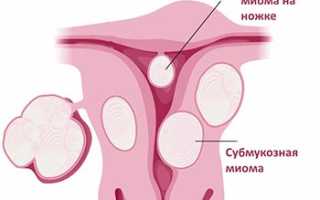 Субмукозная миома матки