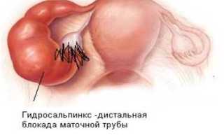 Какая наиболее распространенная причина развития перитонеального бесплодия