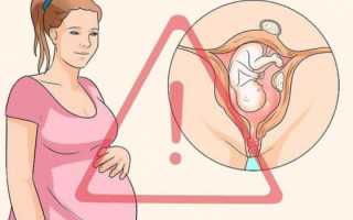 Эндометриоз и бесплодие