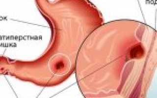 Язва желудка (Язвенная болезнь желудка)