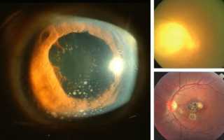 Токсоплазмоз — симптомы и лечение