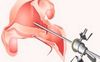 Как определить бесплодие женщины