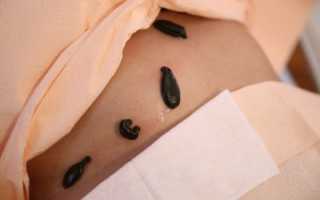 Гирудотерапия при мужском бесплодии