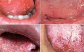 Что делать чтобы убрать синяк (гематому) на языке