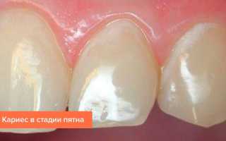 Кариес — это белые, а не черные пятна на эмали, а эксперименты с пастой могут быть опасны