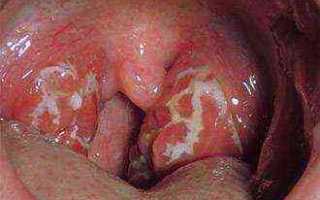 Горло в кровеносных сосудах