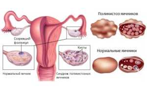 Каких типов бывает бесплодие