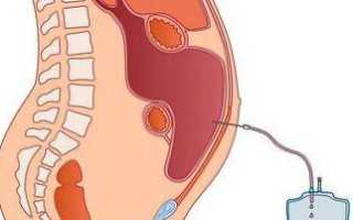 Гиперстимуляция перед ЭКО