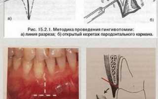 Гингивотомия и гингивэктомия