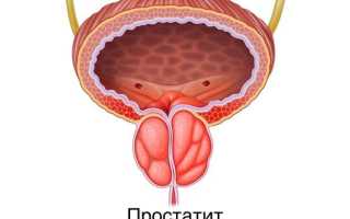 Хронический простатит: как помочь мужчине?