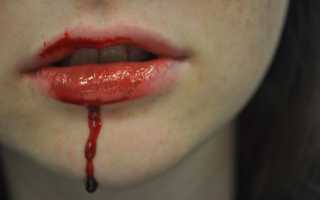 Ожог губ: химический, термический, солнечными лучами