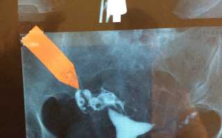 Непроходимость маточных труб