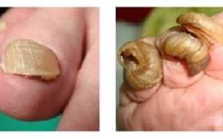 Как восстановить ногти после гель-лака?