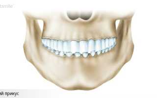 Хирургическое исправление прикуса
