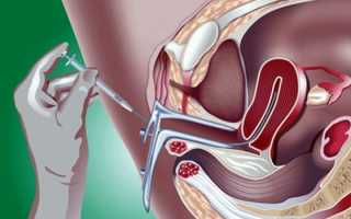 Где в Израиле лечат бесплодие