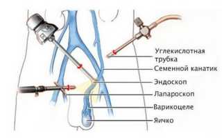 Может ли варикоцеле привести к бесплодию