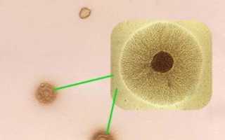 Диагностика и лечение микоплазмоза у женщин