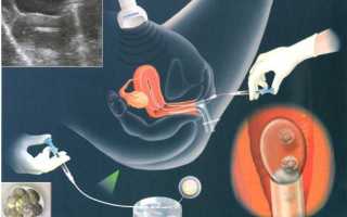 Как происходит имплантация эмбриона при ЭКО