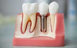 Имплантация или протезирование – что лучше?