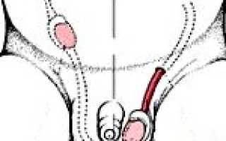 Крипторхизм: причина мужского бесплодия. Распознать проблему вовремя