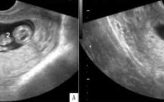 Зачем нужна редукция эмбрионов