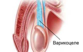 Лечение варикоцеле. Как болезнь связана с мужским бесплодием