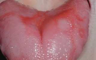 Прыщики на языке у ребенка, причины появления, лечение